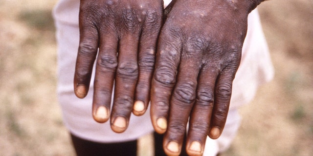 An image created during an investigation into an outbreak of monkeypox, which took place in the Democratic Republic of the Congo (DRC), 1996 to 1997, shows the hands of a patient with a rash due to monkeypox, in this undated image obtained by Reuters on May 18, 2022. 