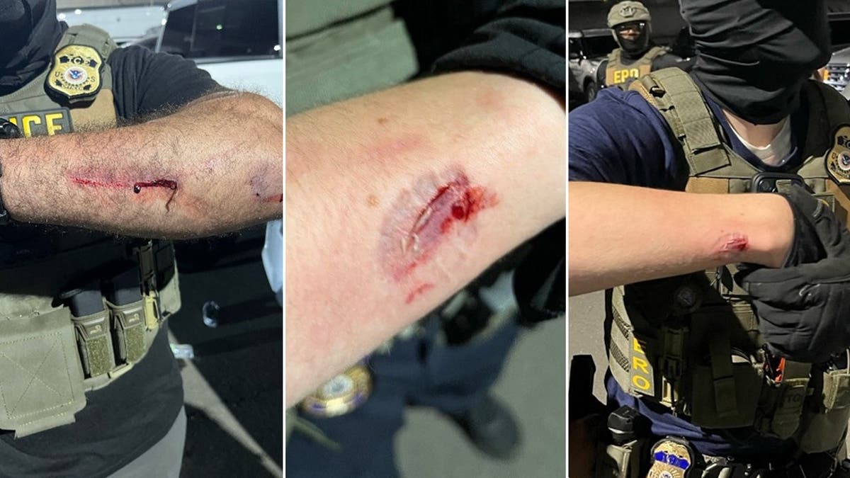 Immigration agents display bloody wounds with bite marks